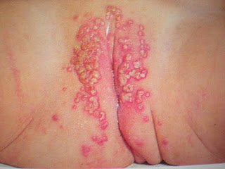 gombás bőrbetegség (microsporiasis))