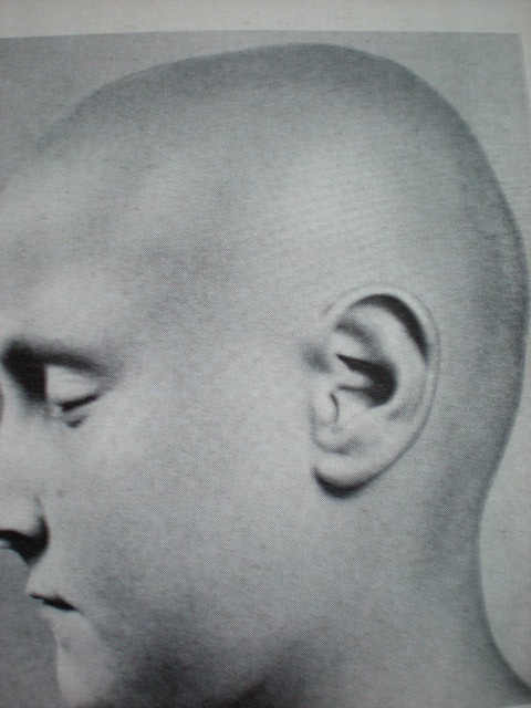 Alopecie totală