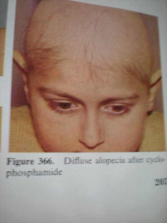 Alopecie după tratament cu steroizi