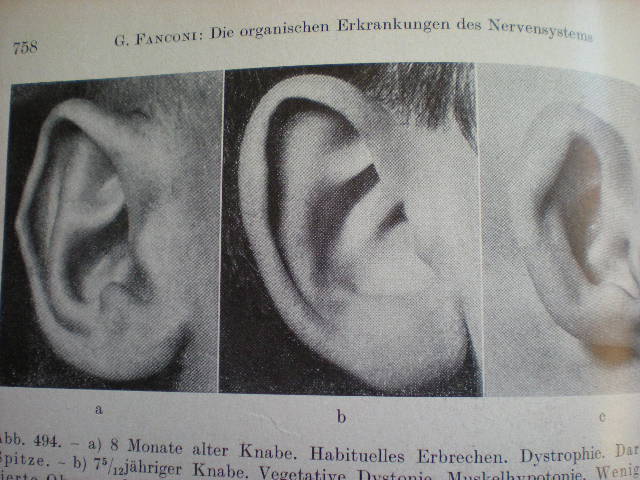 Configuraţii anatomice al pavilionului urechi