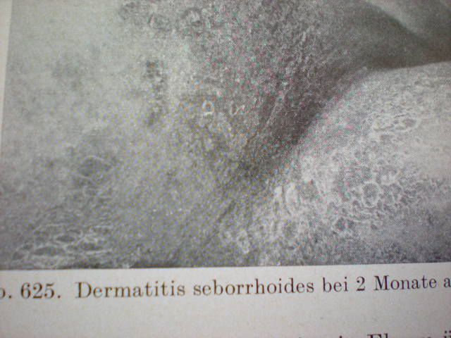 Dermatită seboreică