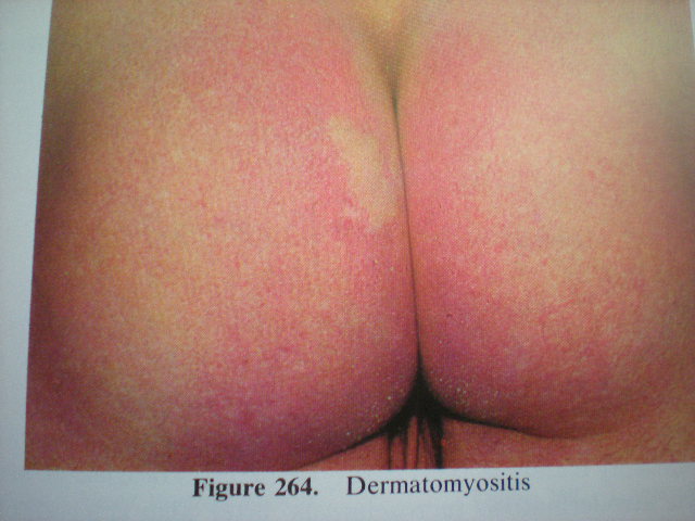 Dermatomiozită
