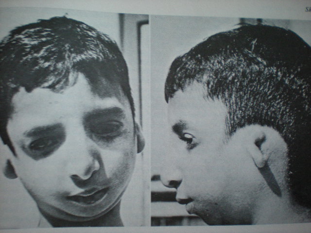 Dismorfism cranio-facial-Sindrom TREACHER-COLLINS