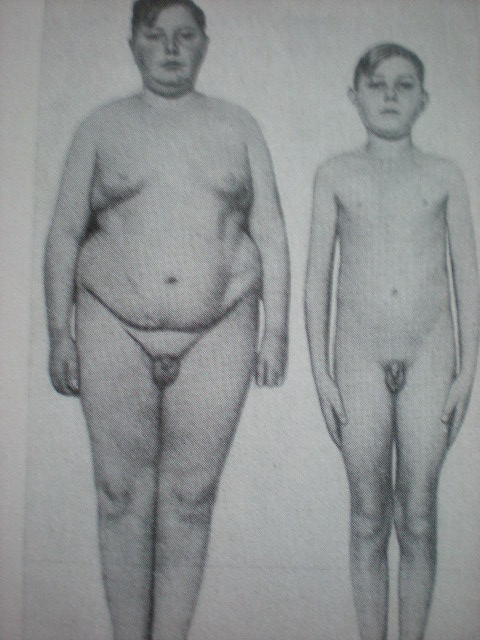 Gigantism-Hipogenitalism-Obezitate