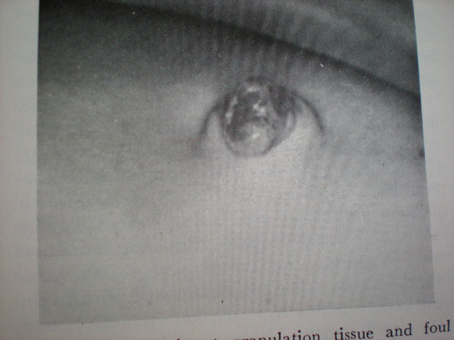 Granulom ombilical