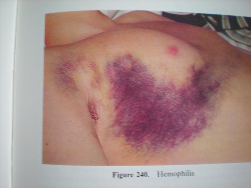 Hemofilie hematom pectoral