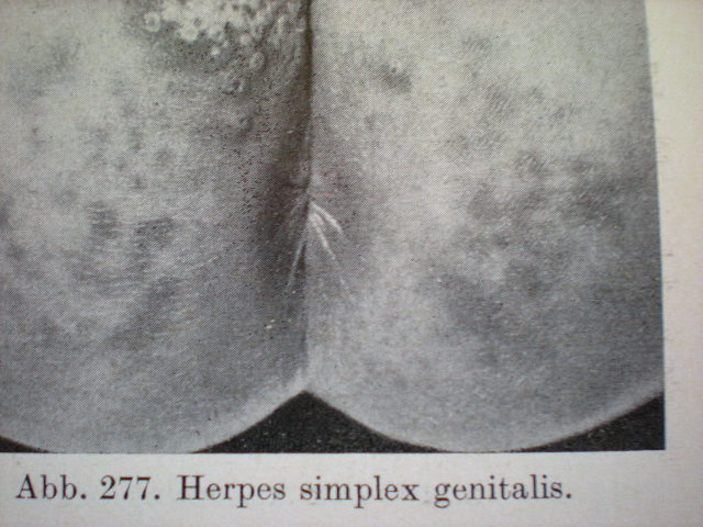 Herpes genital la copil