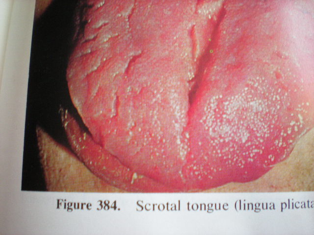 Limba plicaturată-scrotală