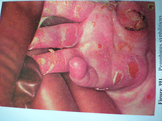 Pemfigus palmar în sifilis