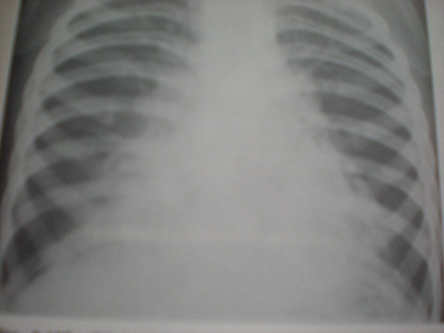 Bronchopneumonie bazală bilaterală