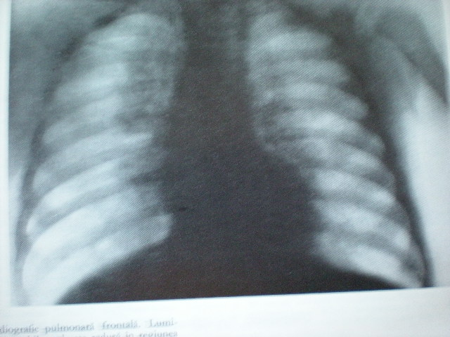 Bronchopneumonie distelectatică paravertebrală