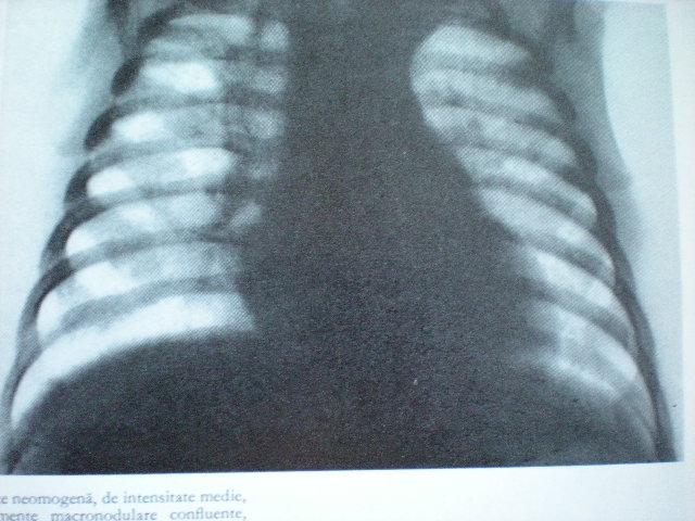 Bronchopneumonie paravertebrală