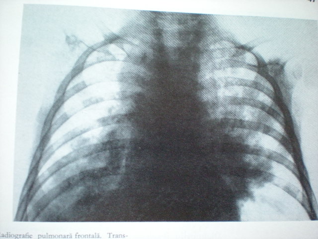 Bronchopneumonie supraacută