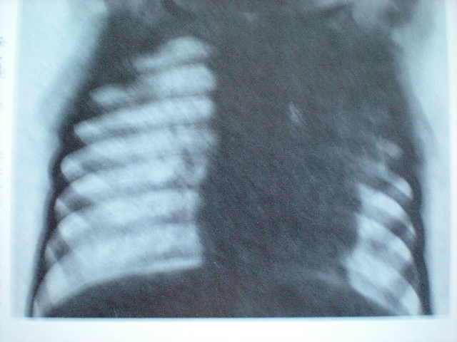 Pneumonie cu localizare în lobul superior stg