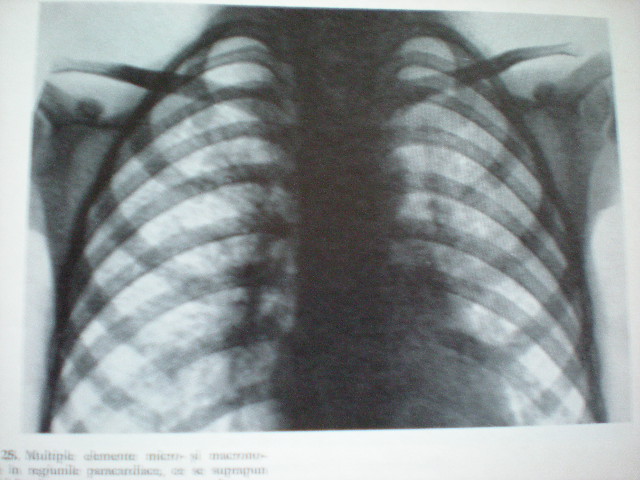 Pneumopatie virală cu sindrom astmatiform