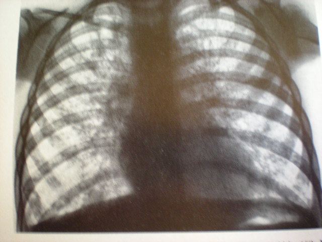 Mucoviscidoză-aspect pulmonar clasic