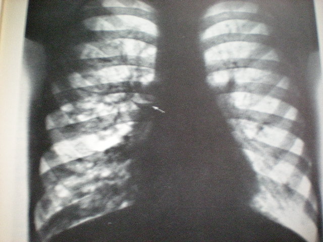 Polichistoză pulmonară
