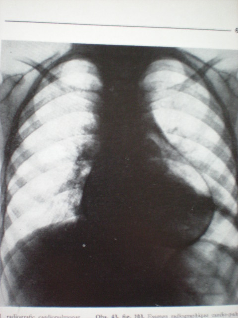 Pneumopericardium