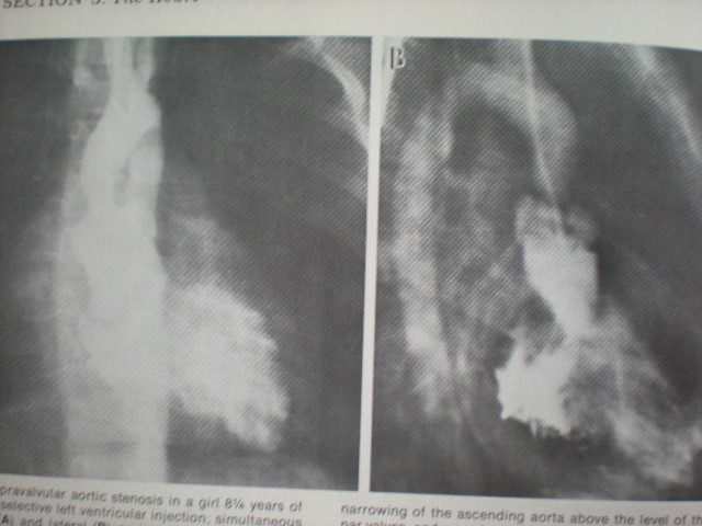 Stenoza aortică supravalvulară