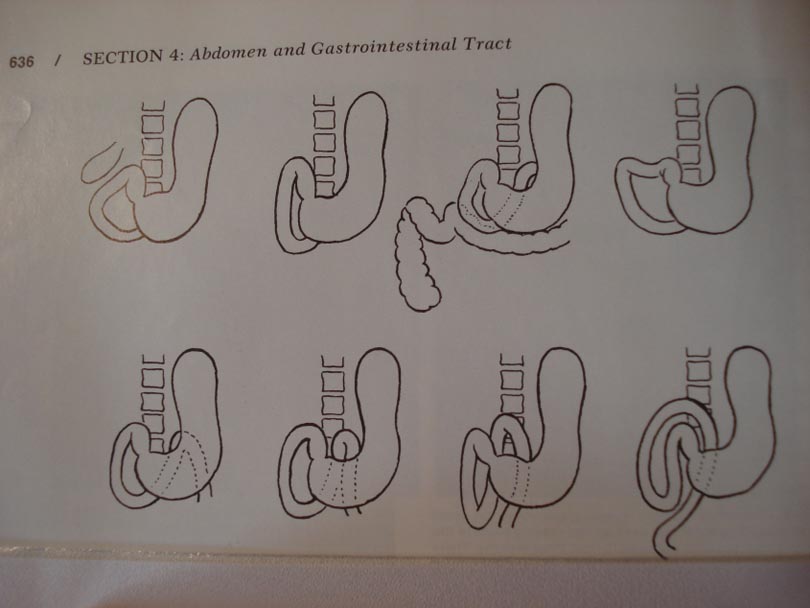 Variante anatomice de malformaţii duodenale