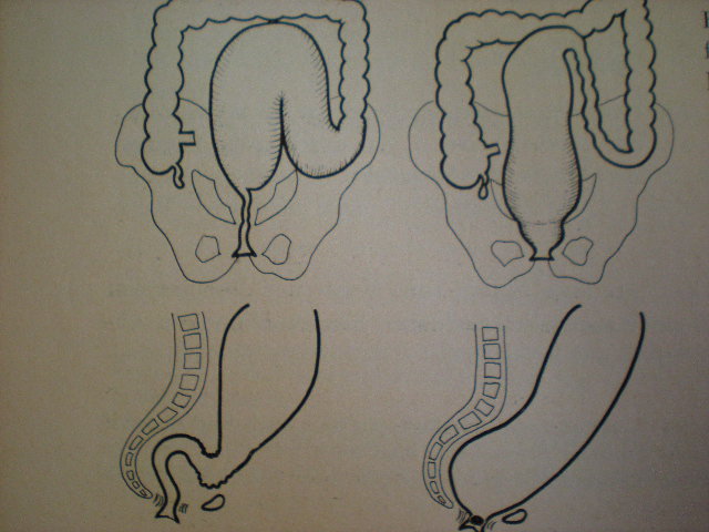 Variante anatomice de megacolon