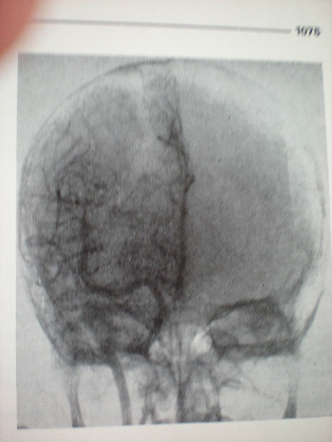 Angiom perieto-occipital drept