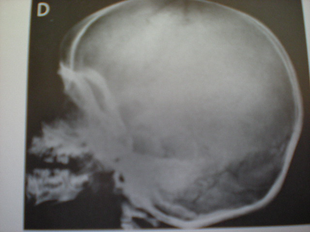 Craniu în osteopetroză