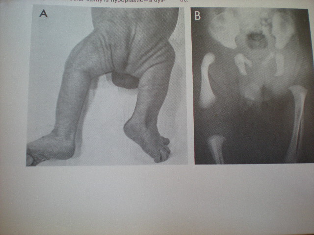 Hipoplazie congenitală a femurului